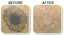 dark tattoo removal