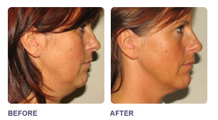 laser skin contouring