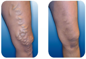 Endovenous Therapy In The Pittsburgh, PA Area