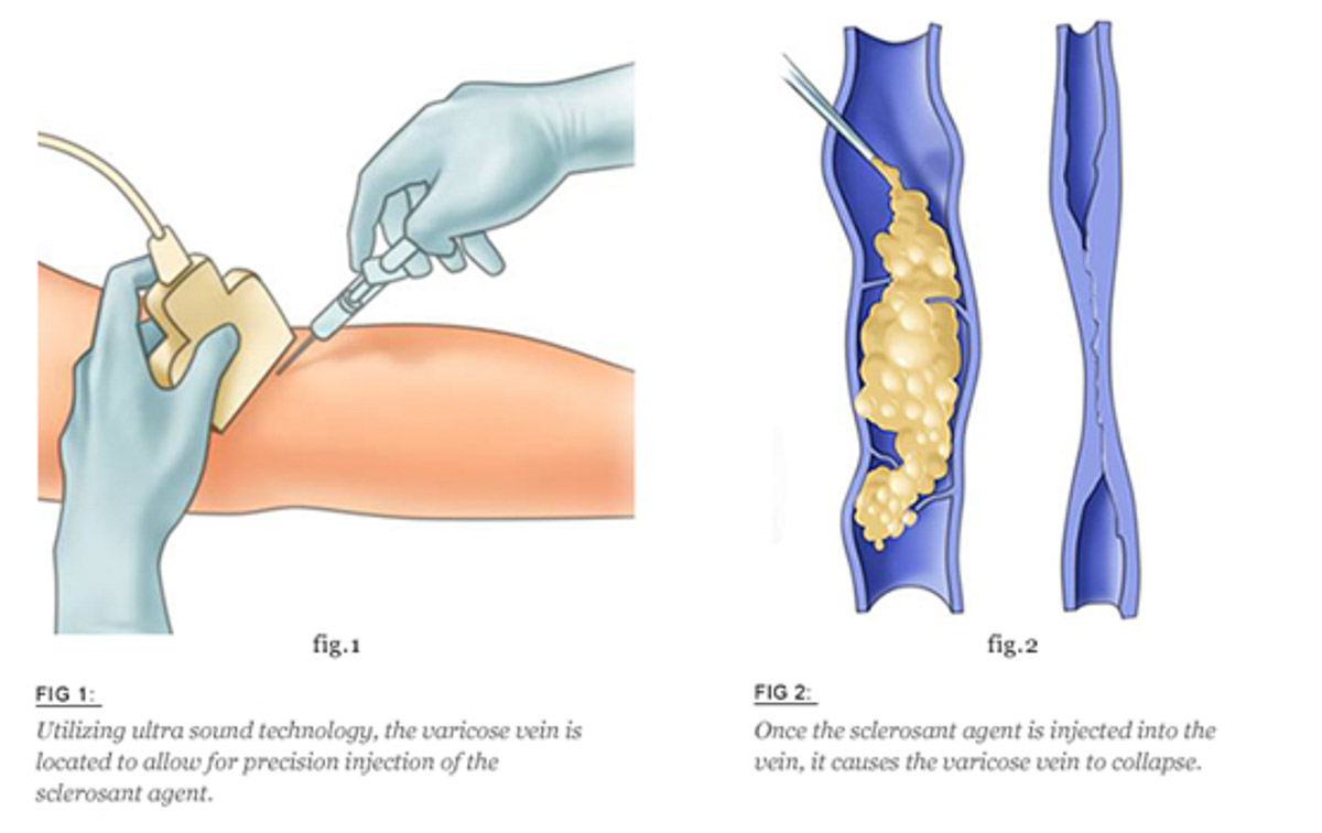 sclerotherapy pittsburgh pa